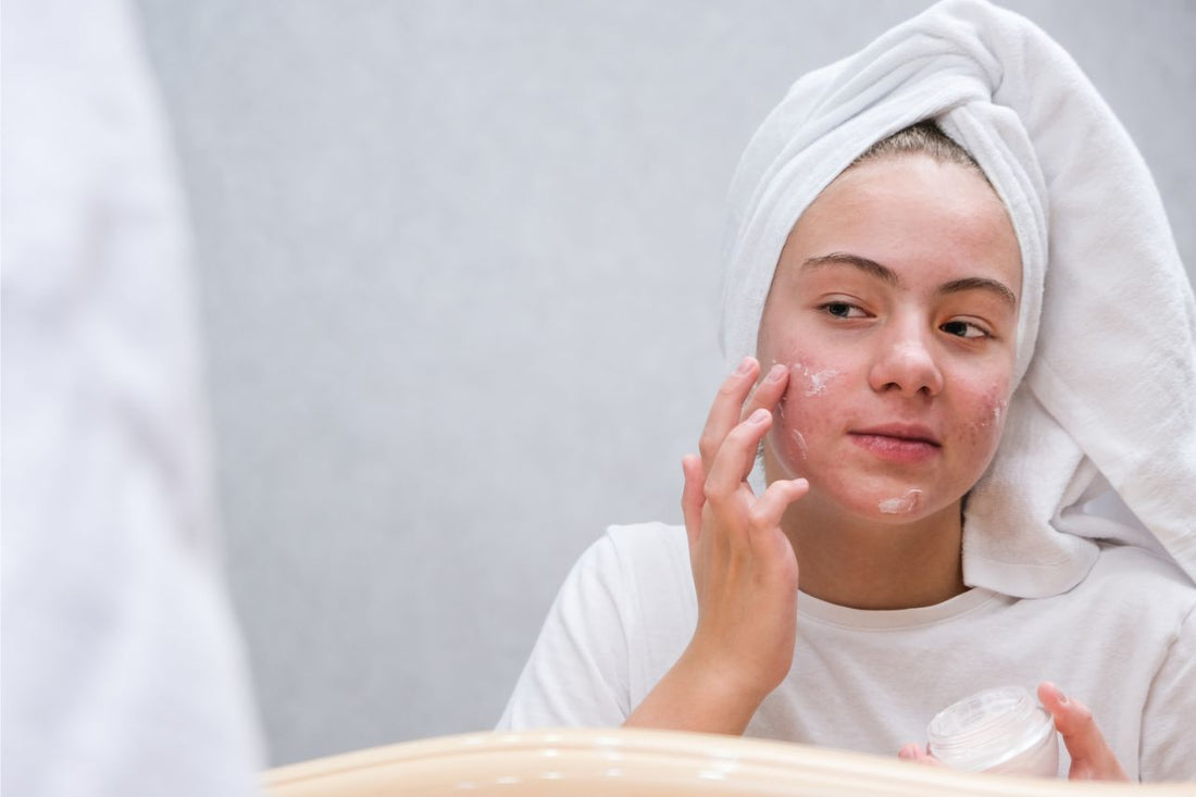 Probiotische Hautpflege bei (hormoneller) Akne
