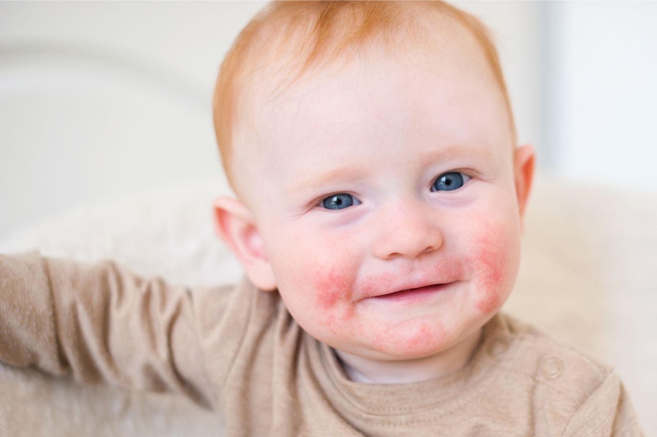 Probiotische Hautpflege bei Perioraler Dermatitis - Hilft das?