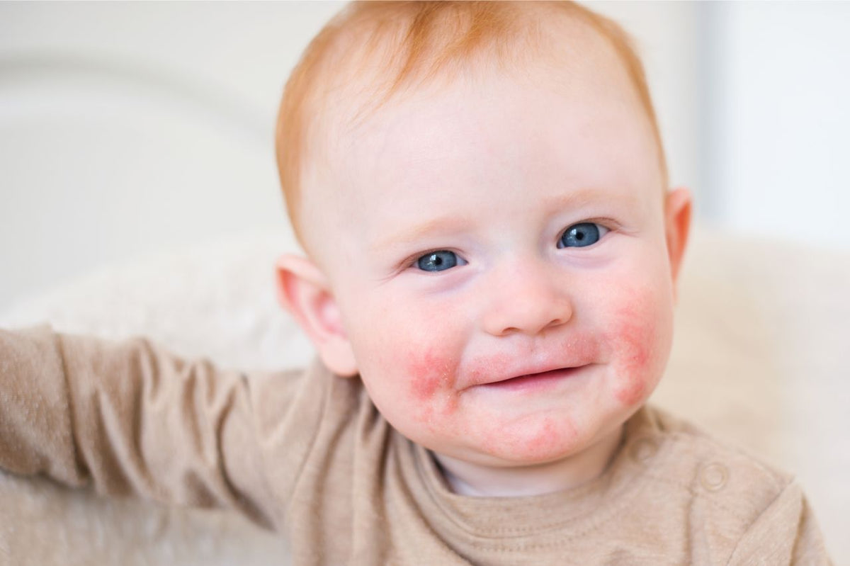 Probiotische Hautpflege bei Perioraler Dermatitis - Hilft das?