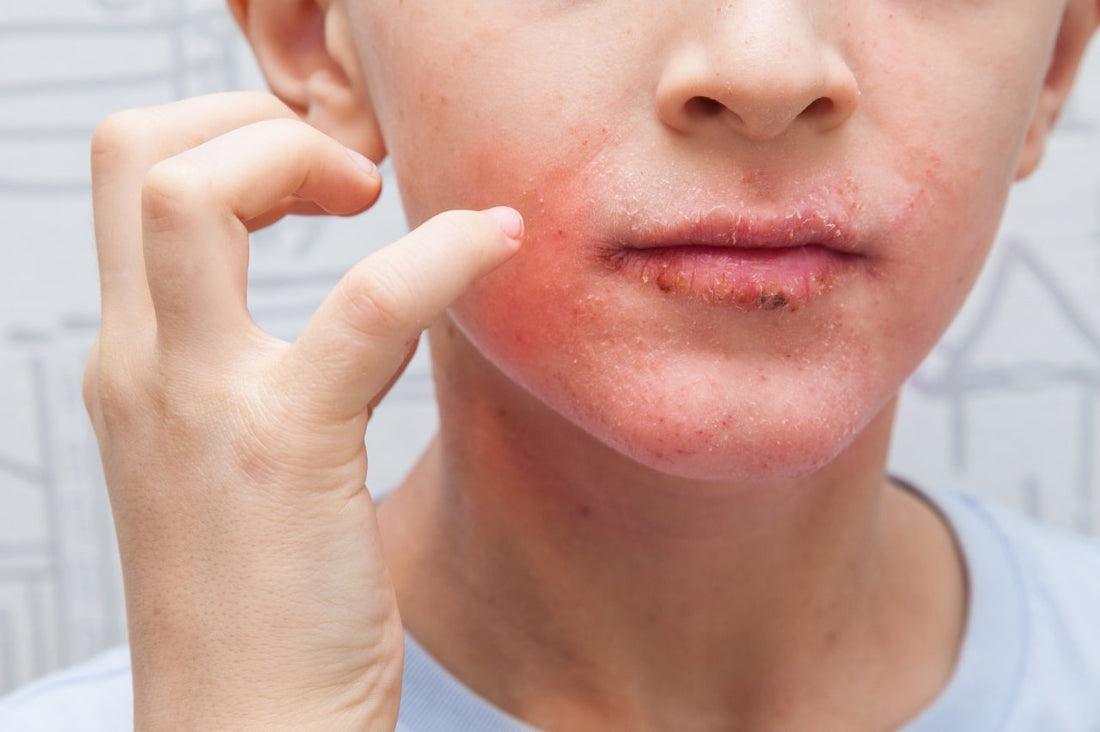 Probiotische Hautpflege bei Neurodermitis