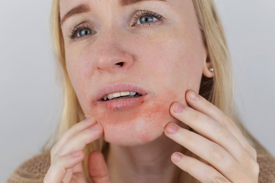 Probiotische Hautpflege bei Schuppenflechte