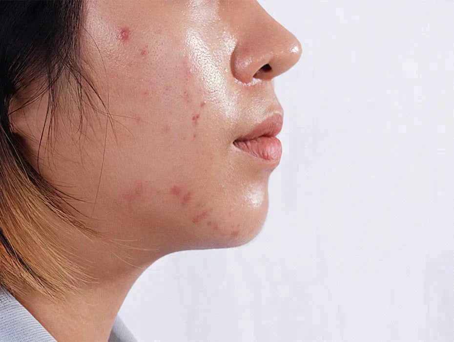 Was tun bei fettiger, glänzender Haut?